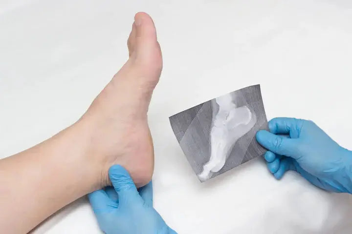 What Does The Heel Spur Treatment Look Like? DrLuigi