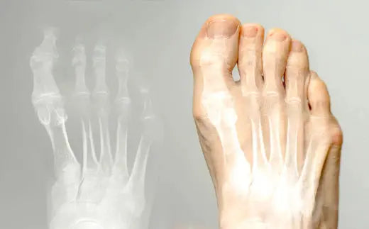 Managing Hallux Rigidus: A Comprehensive Approach DrLuigi