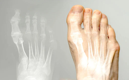 Managing Hallux Rigidus: A Comprehensive Approach