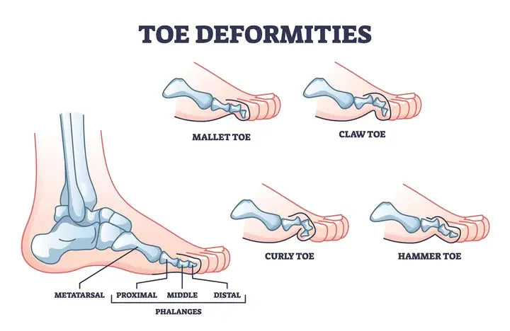 Hammer, Claw, and Mallet Toe DrLuigi