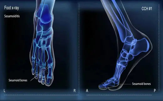 Understanding and Managing Sesamoiditis DrLuigi
