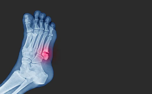 Understanding Various Foot Fractures and Their Management
