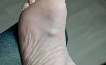 Plantar Fibromatosis DrLuigi