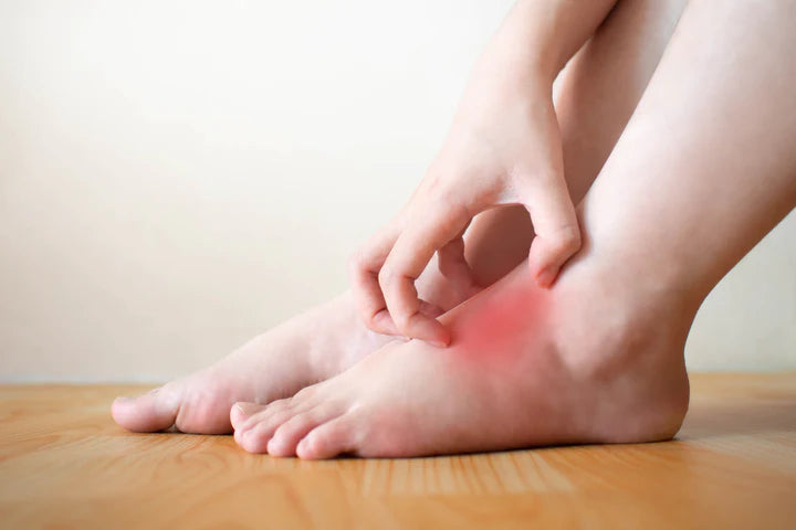 Foot Eczema