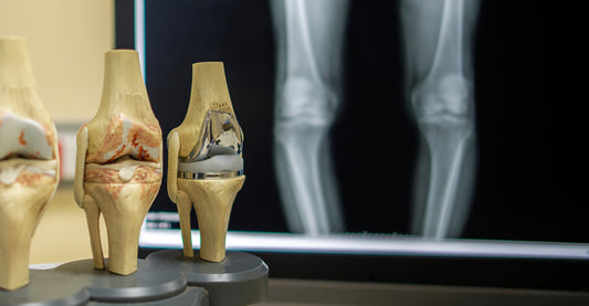 Osteoarthritis