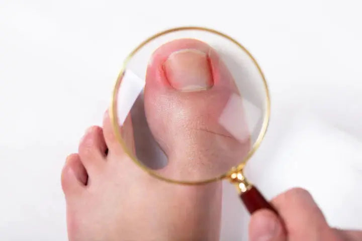 Ingrown nails DrLuigi