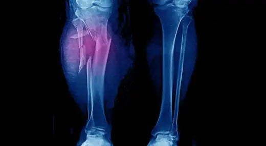 Understanding Compartment Syndrome: Symptoms, Diagnosis, and Treatment DrLuigi
