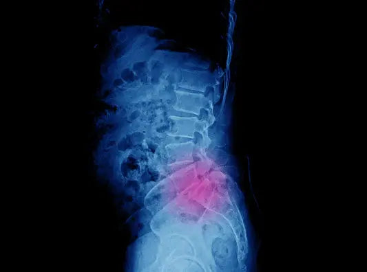Plantar Fasciitis vs. Lumbar Radiculopathy DrLuigi