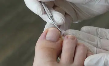 Treatments for Ingrown Toenails: Natural, Medical, and More DrLuigi