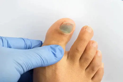 Understanding Black Toenails DrLuigi
