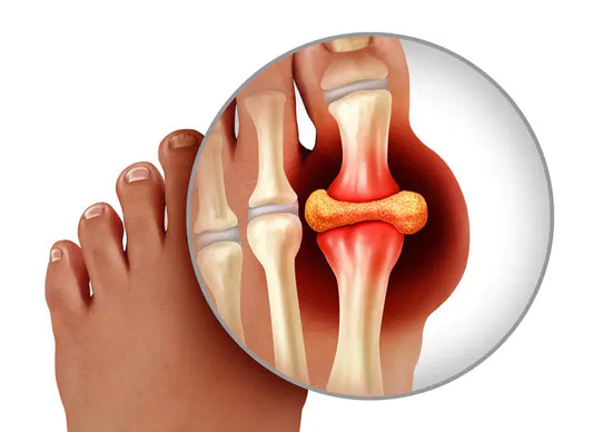 What is Gout? DrLuigi