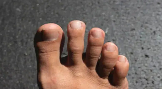 Plantar Fibroma: Understanding, Diagnosis, and Treatment DrLuigi