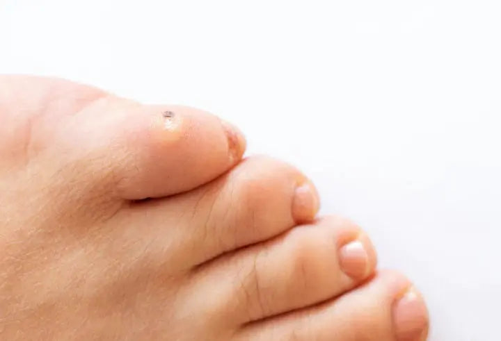 Understanding Verrucae: Causes, Symptoms, and Treatment Options DrLuigi
