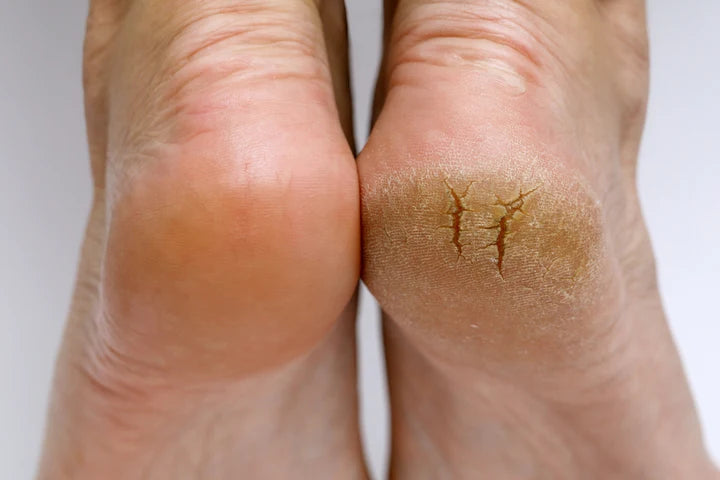 Home Remedies for Peeling Skin & Dry Feet