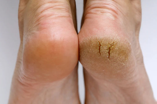 Home Remedies for Peeling Skin & Dry Feet