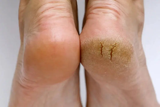 Home Remedies for Peeling Skin & Dry Feet DrLuigi