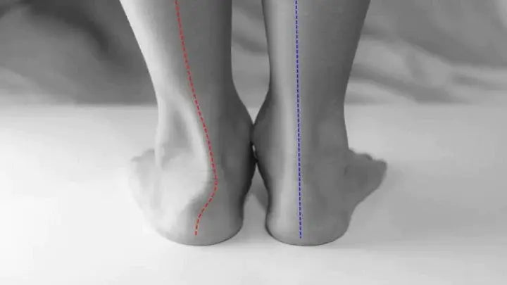 Are fallen arches a real foot problem, or just a label for chronically sore feet DrLuigi