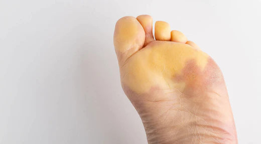 Understanding Scleroderma: Symptoms, Effects, and Treatment