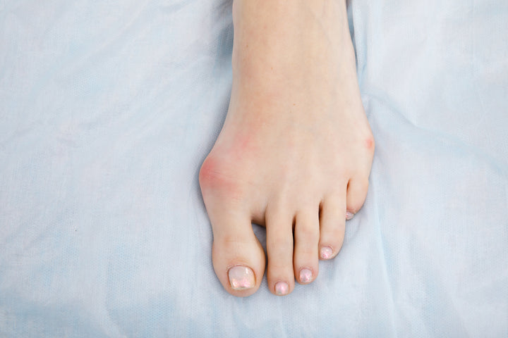 What is bunion removal surgery, when is it recommended, what to expect, and other information
