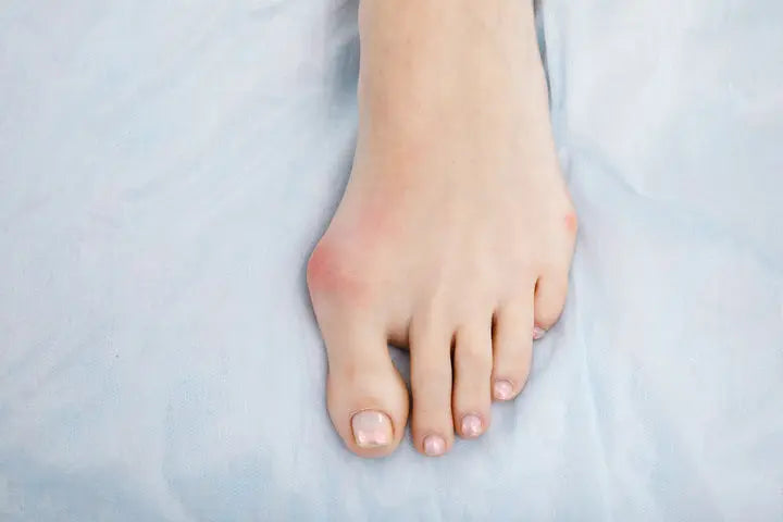 What is bunion removal surgery, when is it recommended, what to expect, and other information DrLuigi