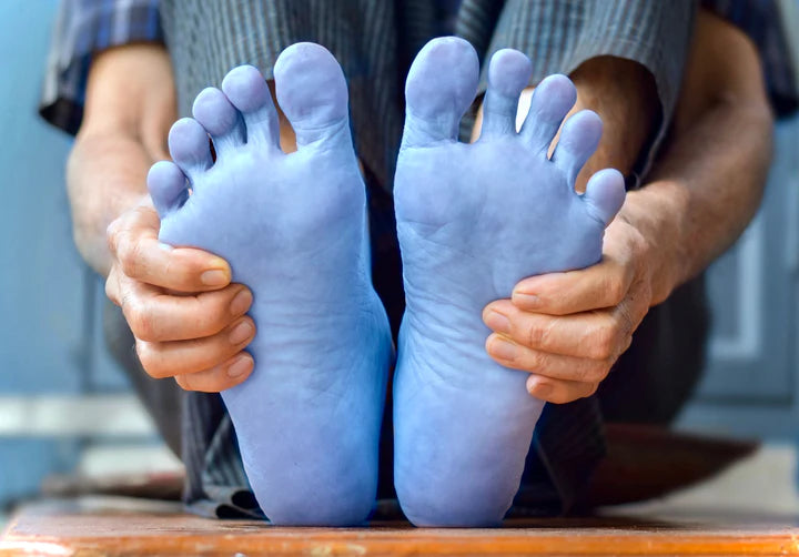 Blue toe syndrome