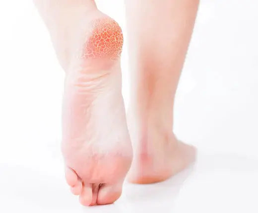 Optimal Foot Care for Dry Skin DrLuigi