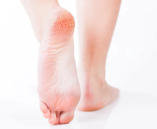 Optimal Foot Care for Dry Skin