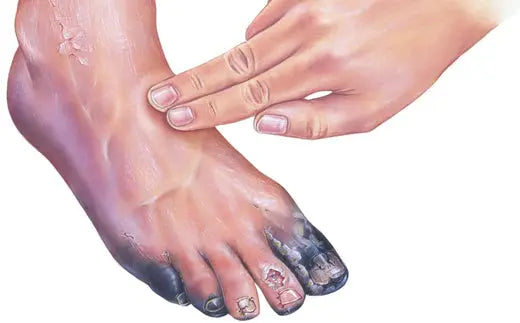 Understanding Gangrene: Types, Symptoms, Causes, and Prevention DrLuigi