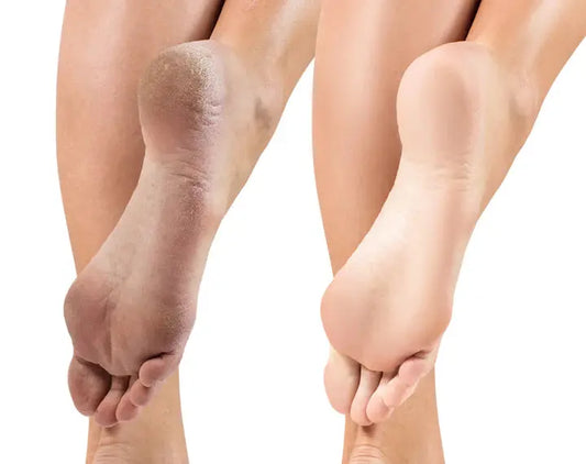 Why Females Are More Prone to Foot Issues Than Males? DrLuigi